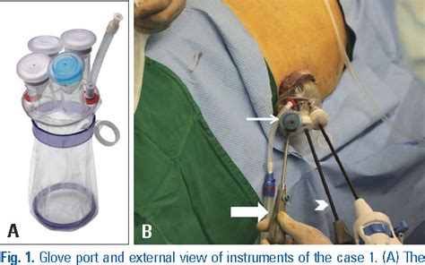 Figure 1 From Transumbilical Single Port Laparoscopic Adrenalectomy A