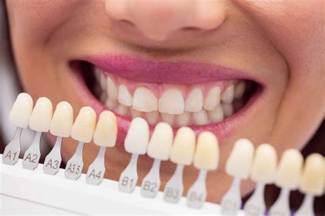 Tipos De Blanqueamiento Dental El Mejor Carlos Saiz Smile