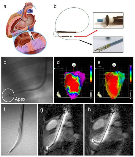 Imaging Navigation Of Transendocardial Delivery A Schematic Displays