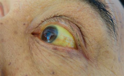 Jaundice Underlying Causes Symptoms Types And Treatment Factdr