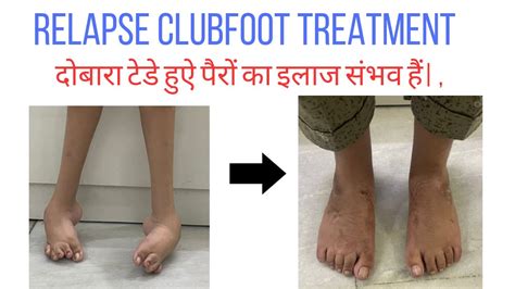 Relapse Clubfoot Can Be Treated Ll Relapse Clubfoot Ll Clubfoot