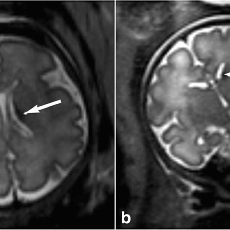 Grade 1 germinal matrix haemorrhage in a 33¹ weeks gestational age