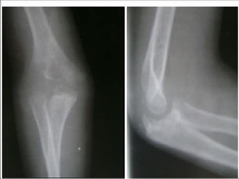 Radiographs, ten months after open reduction, show normal articulation... | Download Scientific ...