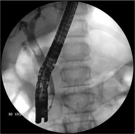 Cholangiogram Demonstrating Dilated Common And Extra Hepatic Bile Ducts Download Scientific