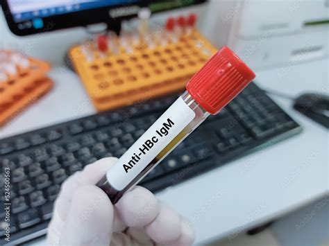 Biochemist of Scientist holds blood sample for Anti HBc IgM test ...