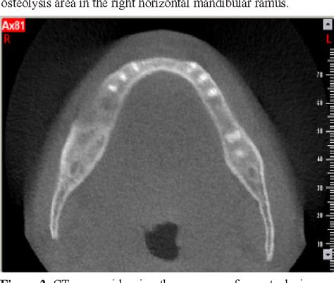 Figure 1 From Mandibular Reconstruction Using Free Vascularized Iliac Crest Grafts And Dental