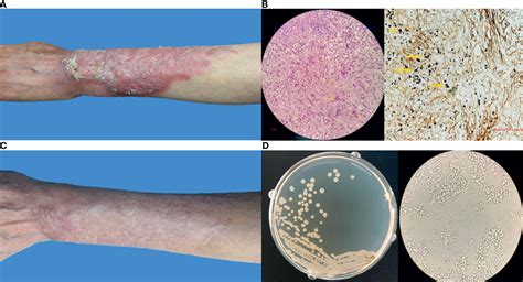 Frontiers First Case Of Subcutaneous Mycoses Caused By Dirkmeia