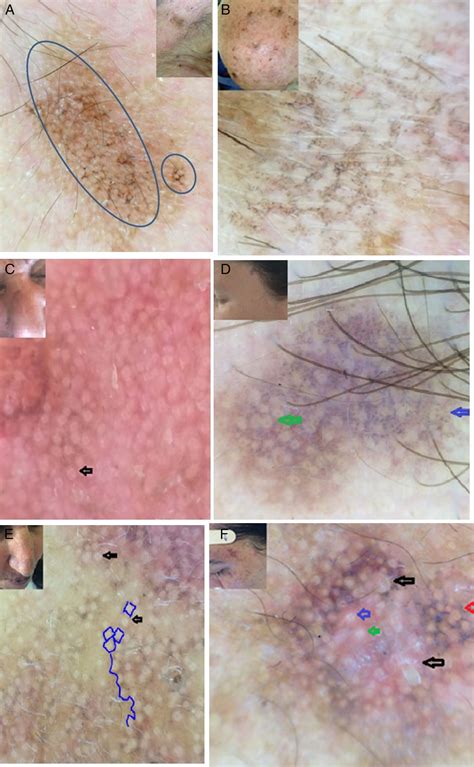 Dermoscopy of Pigmented Actinic Keratosis of the Face: A Study of 232