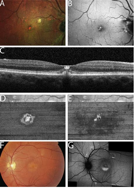 Figure 1 From Adult Onset Foveomacular Vitelliform Dystrophy A Fresh Perspective Semantic Scholar