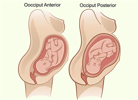 🎖 Occiput Posterior ¿afecta El Trabajo De Parto Y Cómo Manejarlo