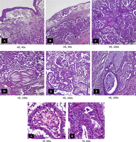 Microscopic Appearance A Well Circumscribed Tumor Lined By Squamous