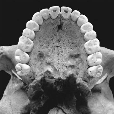 Frontal View Of The Processus Alveolaris Of The Adult Bad D Rrenberg