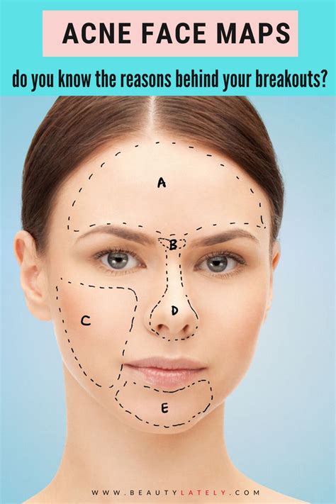 Acne Face Maps What Do Your Breakouts Say About Your Health Face