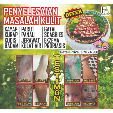 Mini Cream Masalah Kulit Gatal Eczema Fungus Ubat Kurap Kudis Krim