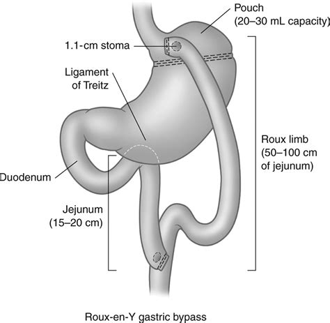 Roux En Y Gastric Bypass Anatomy