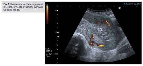 Ultrasound Monitoring Of Uterine Involution In The Postpartum Period