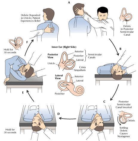 inner ear crystals Epley maneuver | Positional Vertigo: Get Medical ...