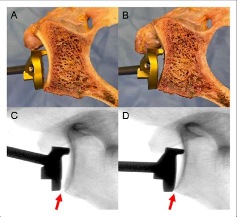 Images Show The Aspect Of A Glenoid Instrumentation Guide Sitting At