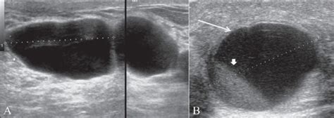 Fibrocystic Breast Disease Causes Symptoms Treatment