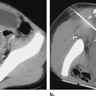 Transgluteal Abscess Drainage Cpt Code Best Drain Photos Primagem Org