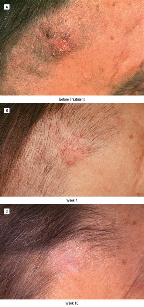 Successful Treatment Of Invasive Squamous Cell Carcinoma Using Topical