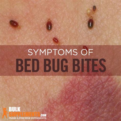 Bed Bug Bites: Characteristics, Causes & Treatment