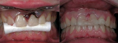 Figure 3 From Horizontal Root Fracture Treated With Mta A Case Report With A 10 Year Follow Up