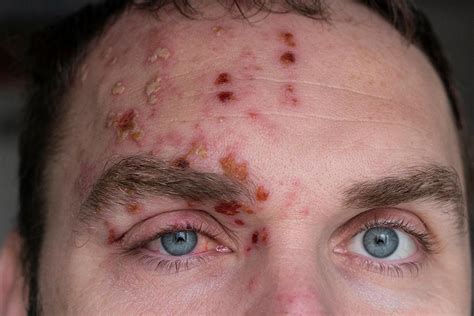 What You Need To Know About Shingles Of The Eye Scott Beeve Md