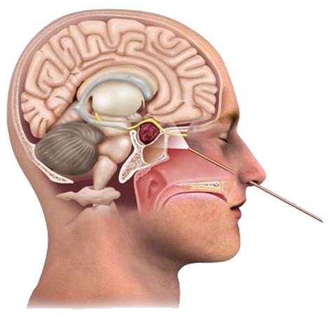 Skull Base Cranial Base Surgery IBS Hospital Delhi