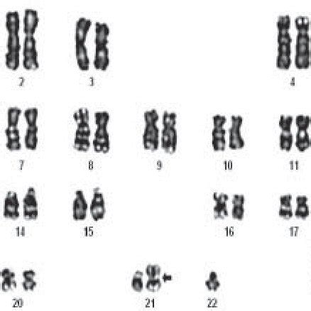 Karyotype showing 45, XX, rob (21,22) chromosome constitution in a ...