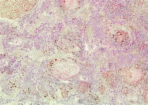 Primary Biliary Cirrhosis Photograph By Nigel Downer Science Photo Library Pixels