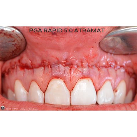 Sutures Dentaire Pga Rapid Atramat Bo Te De Fils Ttc