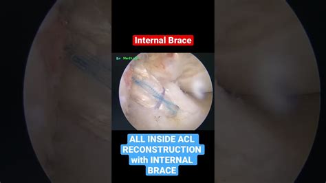 All Inside Acl Reconstruction With Internal Brace Surgery Youtube