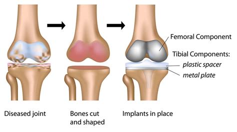 Total Knee Replacement Robin Orthopaedics Melbourne