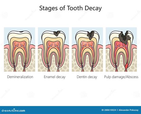 Tooth Decay Caries Stages Diagram Medical Science Stock Illustration