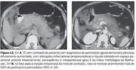 Radiologia Brasileira Tomografia Computadorizada Sem Contraste