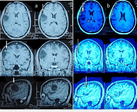 Brain Mri A Pre Operative Brain Mri With Contrast Showing A