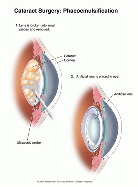 Cataract Surgery Lens Implantation Multifocal Intraocular Lenses