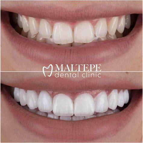 Lumineers Vs Veneers Before After