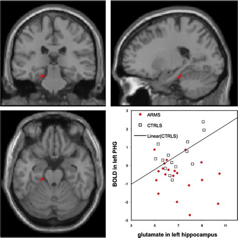 Left Parahippocampal Phg Region X 18 Y 30 Z 20 Where At Risk