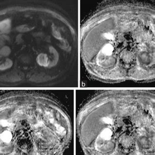 Dwi With B Value A And Adc Maps B C D In A Patient With Apn