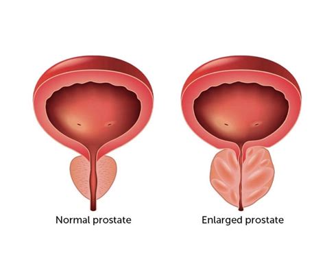 The Best Treatment For Benign Prostatic Hyperplasia Aquablation