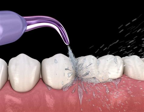 Ultrasonic tooth cleaning: advantages and disadvantages