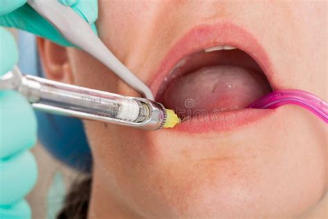 Dental Anesthesia Stock Photo Image Of Medicine Health