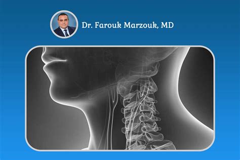 Carotid Stenosis Symptoms - Early Detection And Management