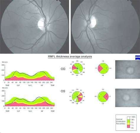 Case Stratus Optical Coherence Tomography Showing Retinal Nerve Fi