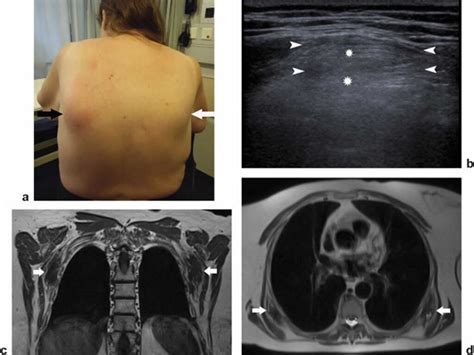 Elastofibroma Dorsi Causes Symptoms Diagnosis Treatment Prognosis