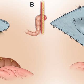 Pdf Parastomal Hernia Repair