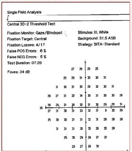 Automated Perimetry Flashcards Quizlet