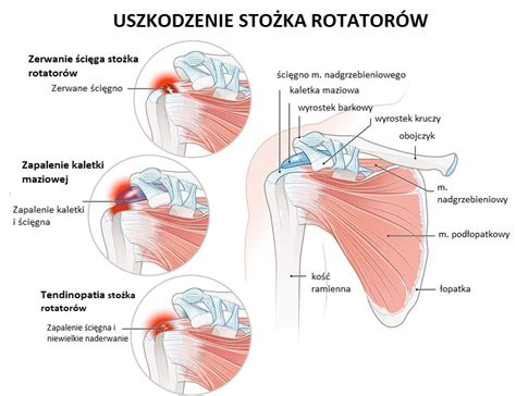 Uszkodzenie stożka rotatorów czym jest i kiedy konieczna jest operacja